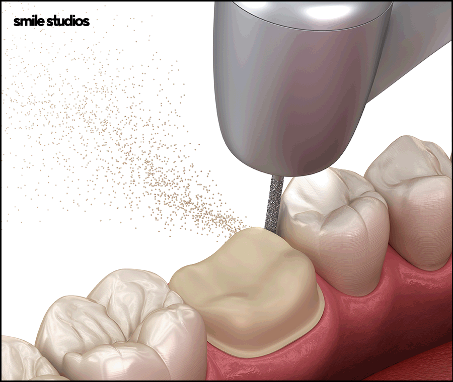 도산대로치과 앞니 라미네이트 크라운 차이점 관련 이미지 3