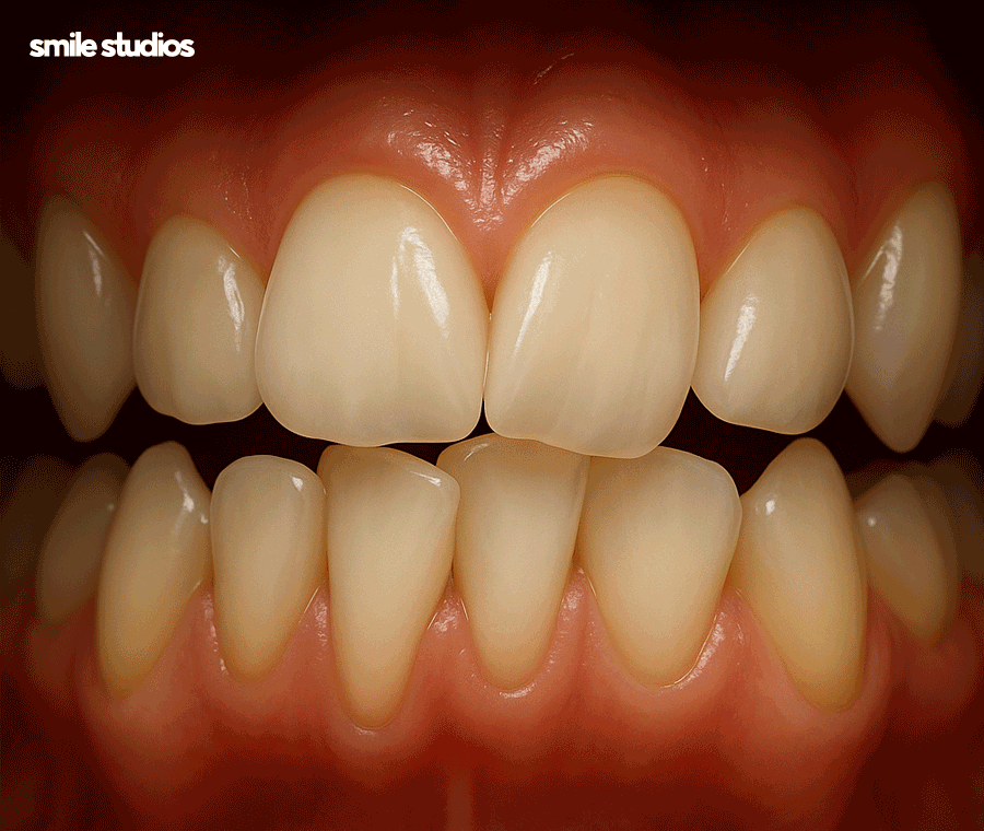 논현 라미네이트 시술 고민된다면 필수체크 관련 이미지 4