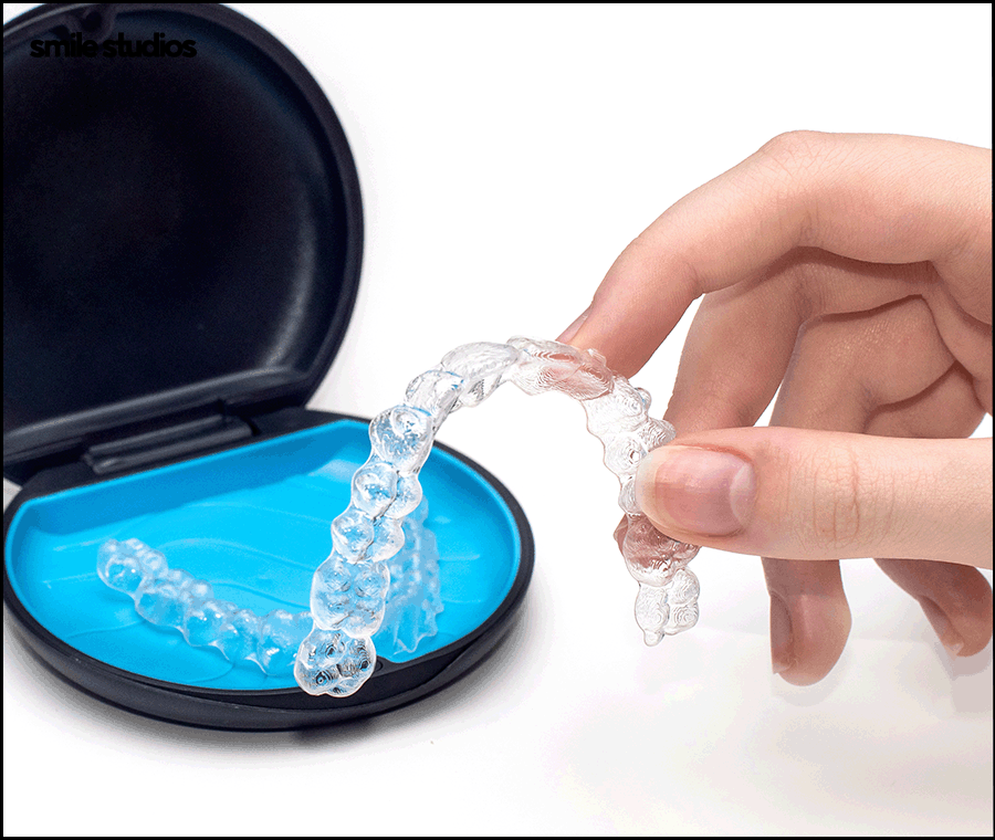 Invisalign Cost, Treatment Duration, and Pre-Treatment Checklist image 3