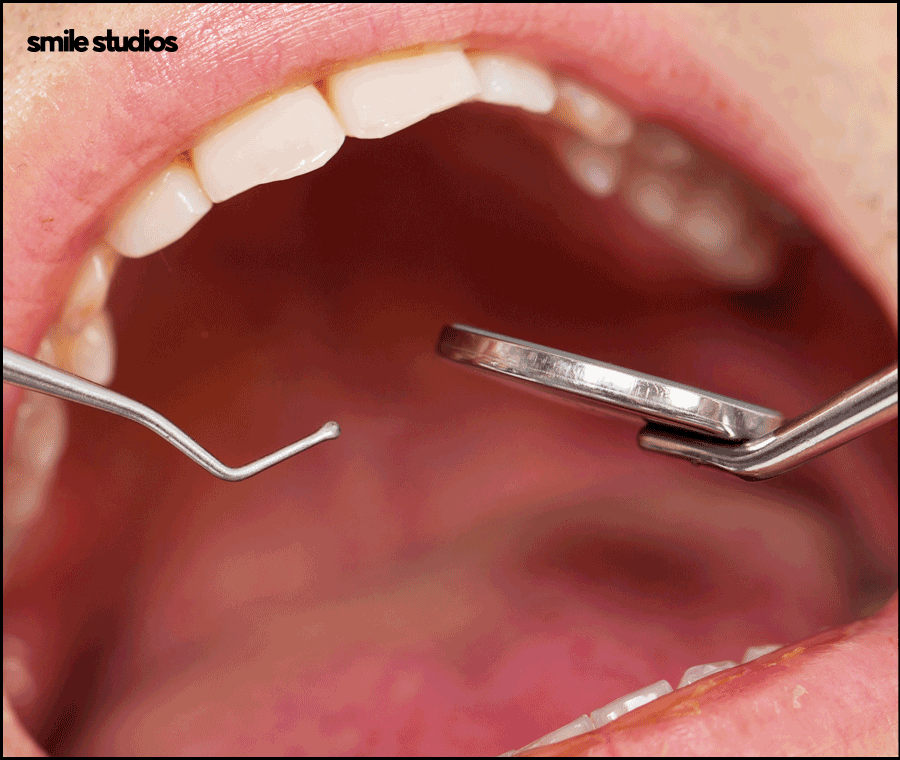 돌출입 인비절라인 기간, 과정, 개선 효과 관련 이미지 3