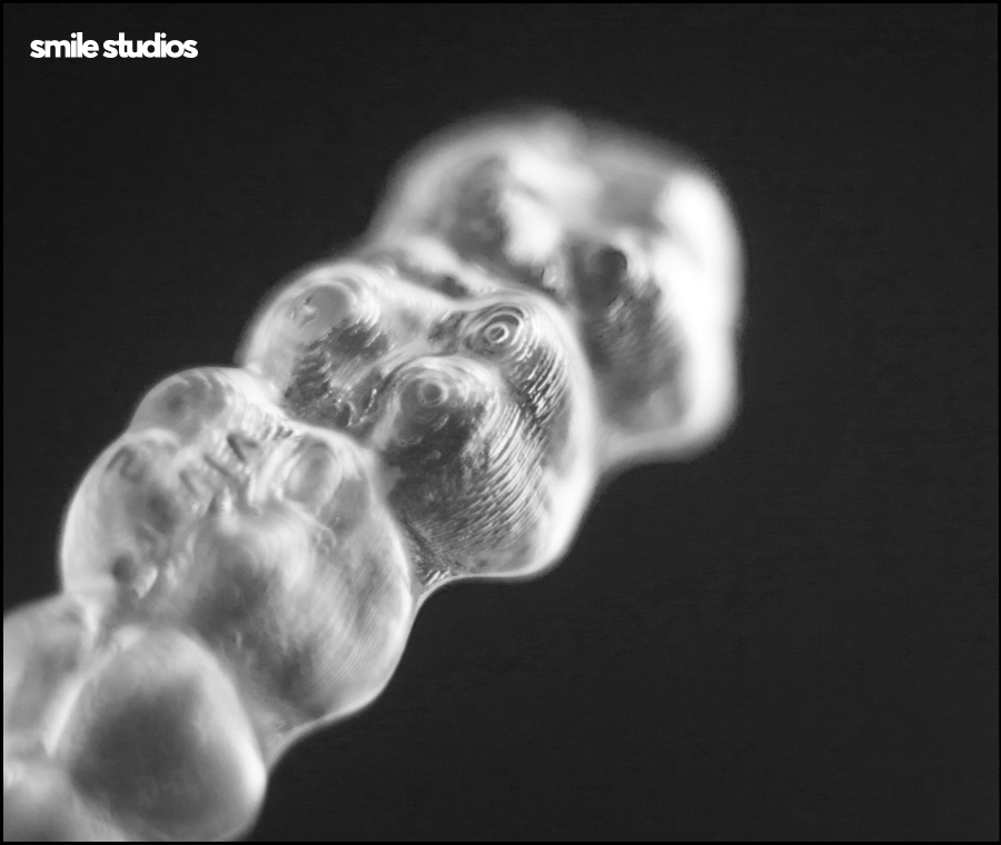 서울인비절라인 권장 케이스, 장점, 치료 시간 정리 관련 이미지 5