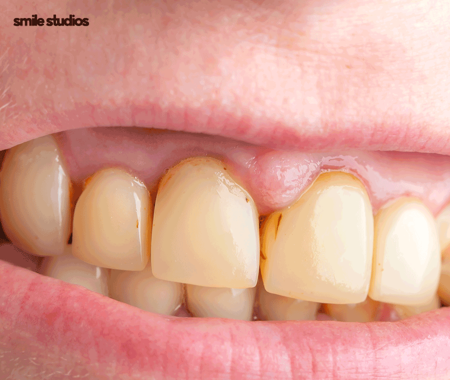 이빨깨짐 치료 치기를 놓치면 위험한 이유는? 관련 이미지 2