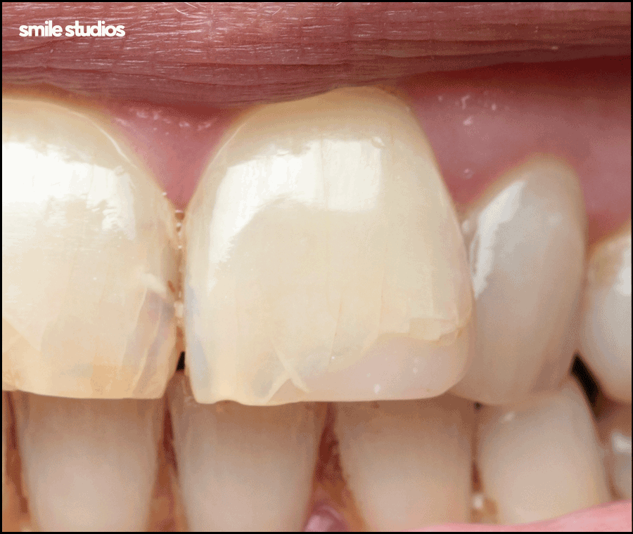 라미네이트 변색, 발생하는 이유, 시점, 대처 방법 관련 이미지 2