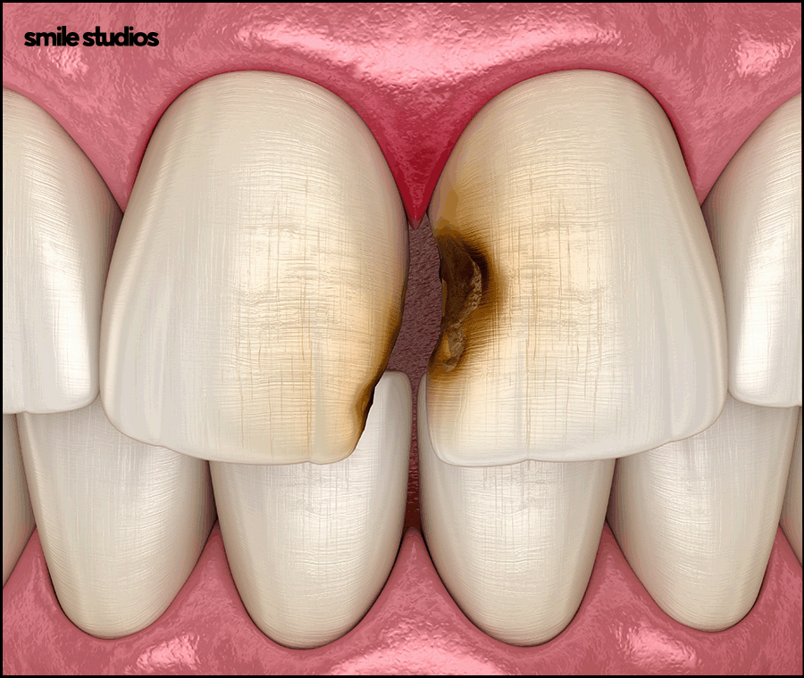 도산대로치과 앞니 라미네이트 크라운 차이점 관련 이미지 5
