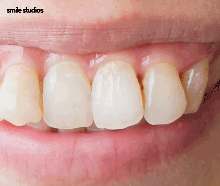 부정교합 치아교정 비용 다른 이유, 함께 체크할 사항 관련 이미지 3