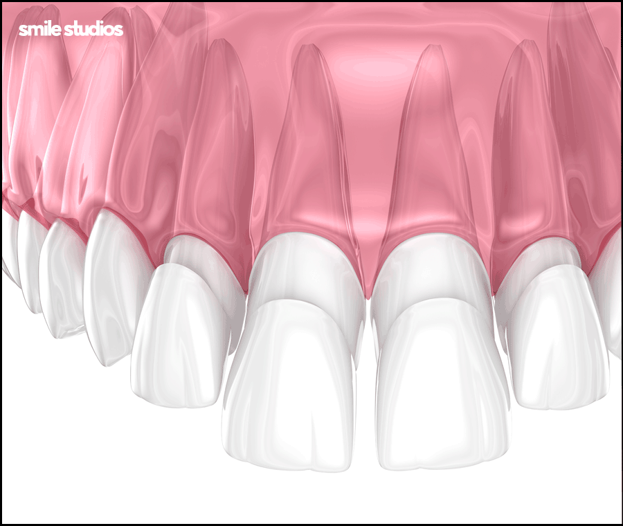 무삭제 라미네이트 효과, 원리, 선호하는 이유 A to Z 관련 이미지 7