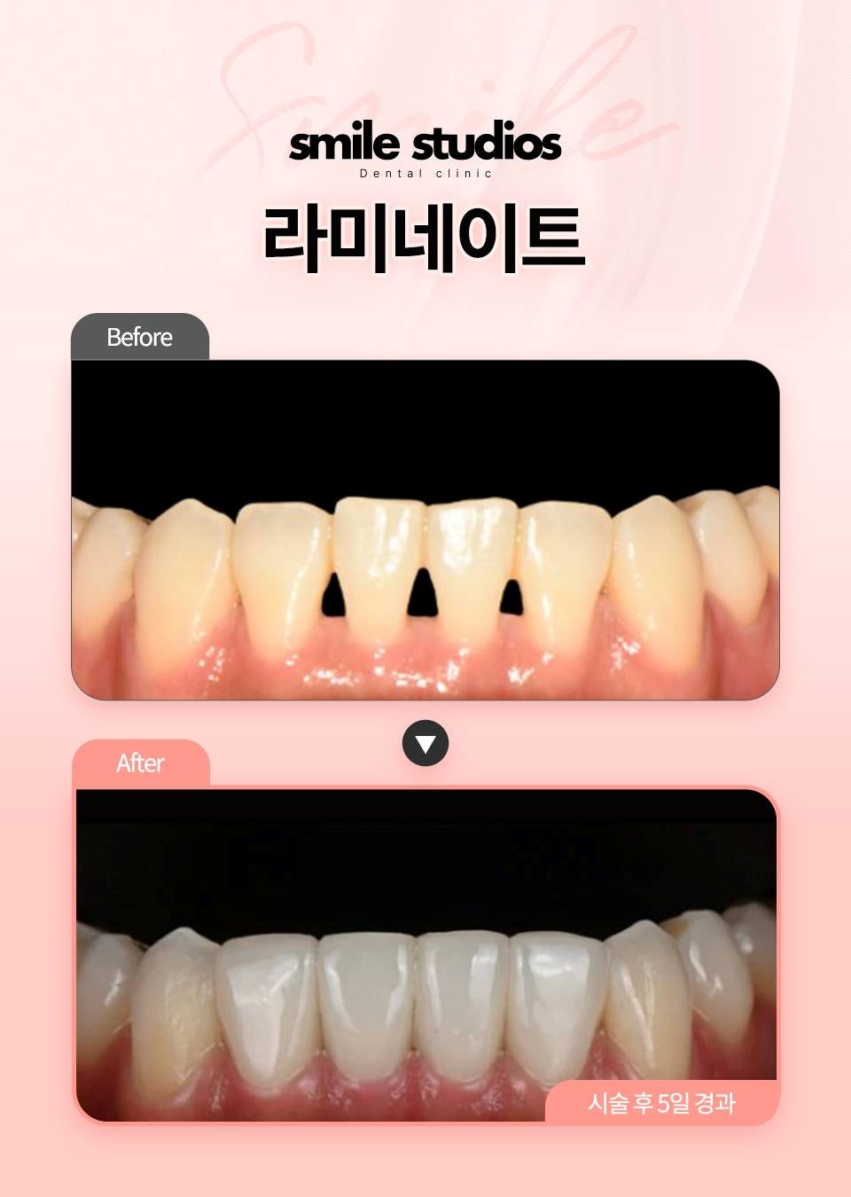 강남역치아미백, 라미네이트로 오래도록 환하게 관련 이미지 7