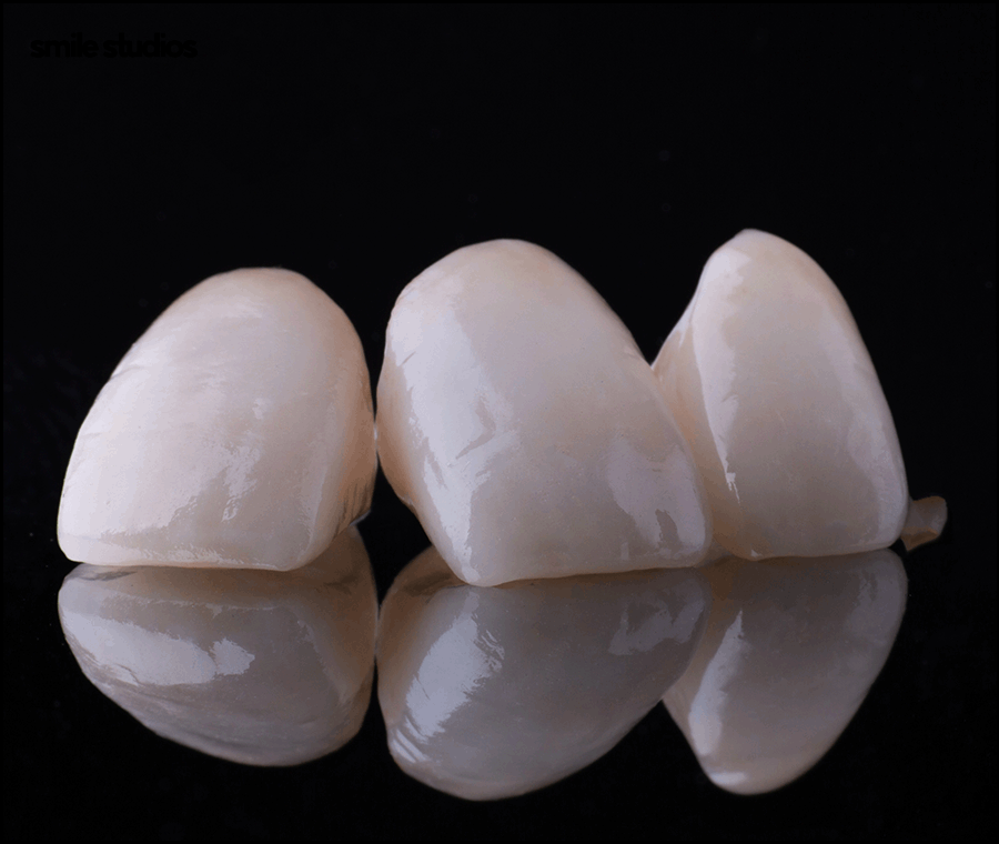 앞니 라미네이트가격 확인 시 같이 체크할 OO은? 관련 이미지 9