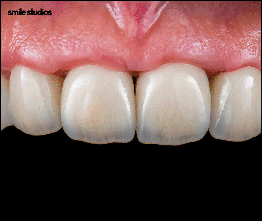 압구정로데오치과 라미네이트 하기 전 체크할 사항 관련 이미지 9