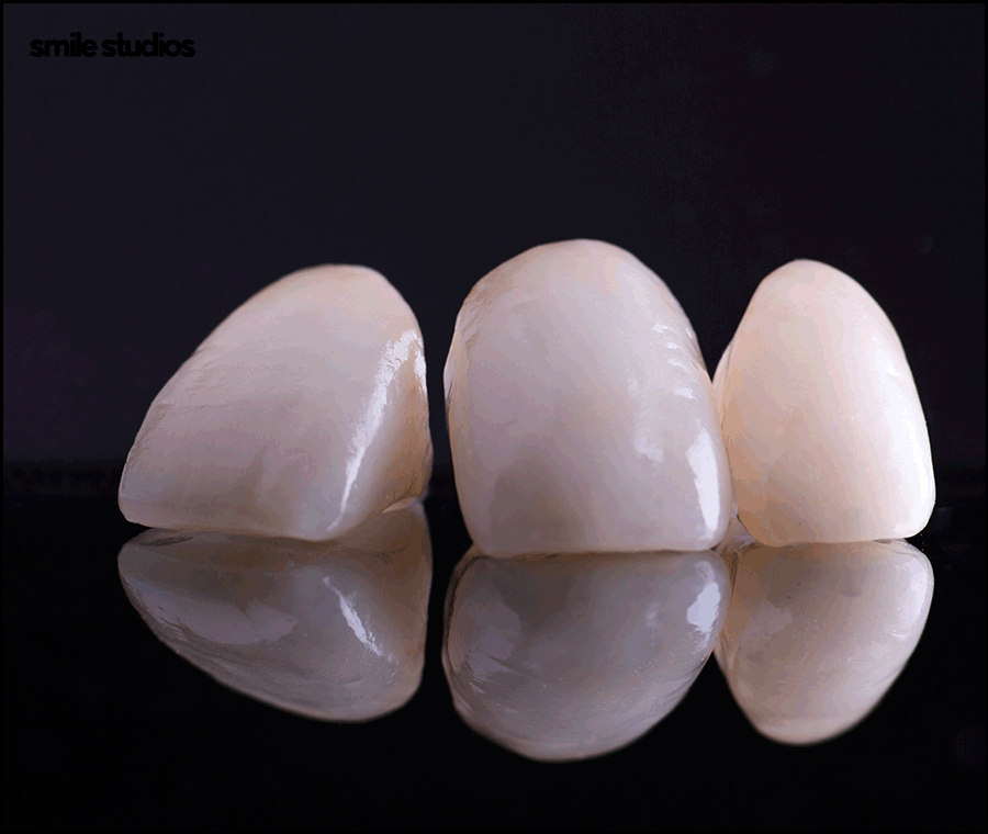 학동역치과 라미네이트 시작 전 확인해야 할 체크사항 관련 이미지 9