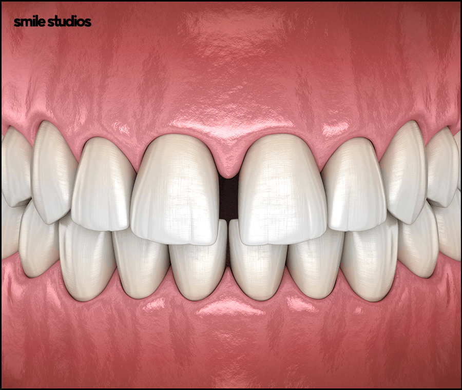 치과라미네이트 고른 치아 만들 때 핵심은? 관련 이미지 2