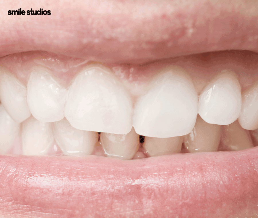 뻐드렁니 교정 성공적인 결과를 위한 key 확인 관련 이미지 4