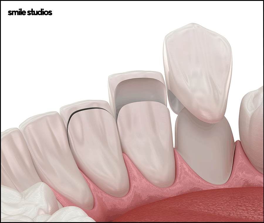 라미네이트 빠짐, 재부착 가능할까요? +대처방법 관련 이미지 9