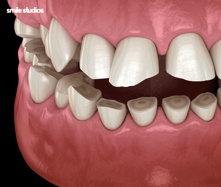 인비절라인 어태치먼트 부착 원리, 탈락 시 대처법 관련 이미지 10