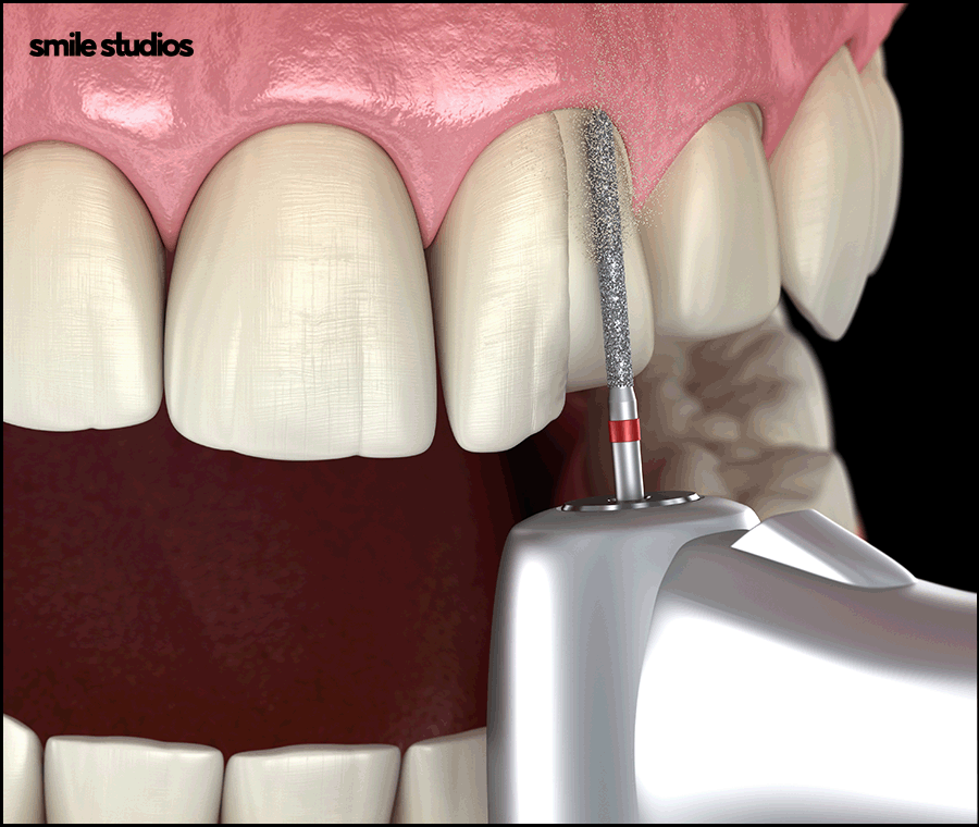 무삭제 라미네이트 효과, 원리, 선호하는 이유 A to Z 관련 이미지 5
