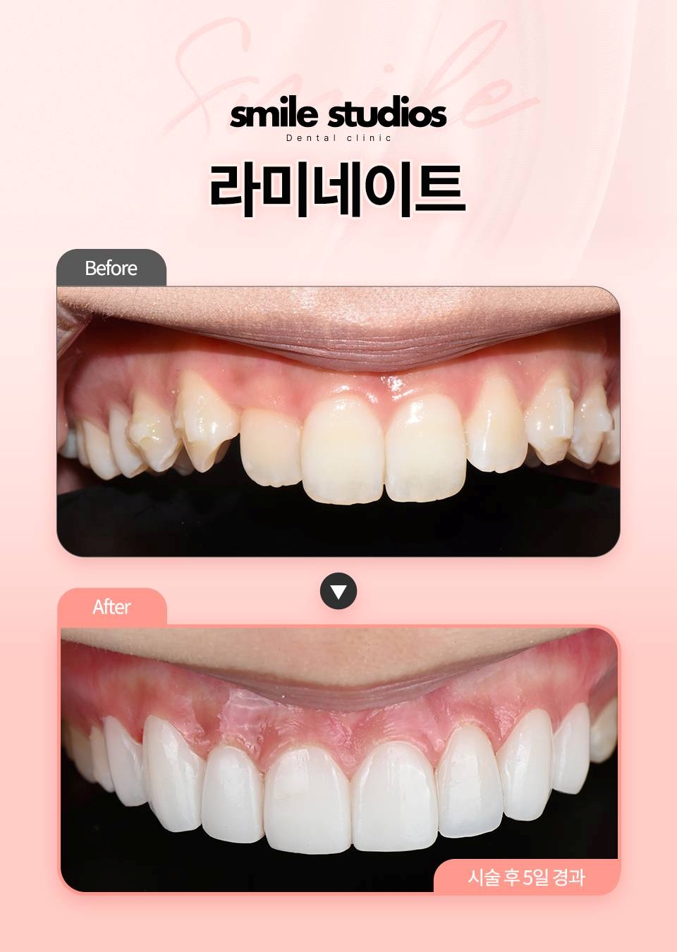 토끼이빨라미네이트, 시간 없다면 더 이상 고민 금지! 관련 이미지 5