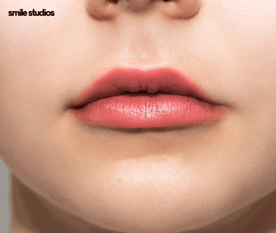 돌출입교정가격 기준 및 효과, 방법 파헤치기 관련 이미지 9