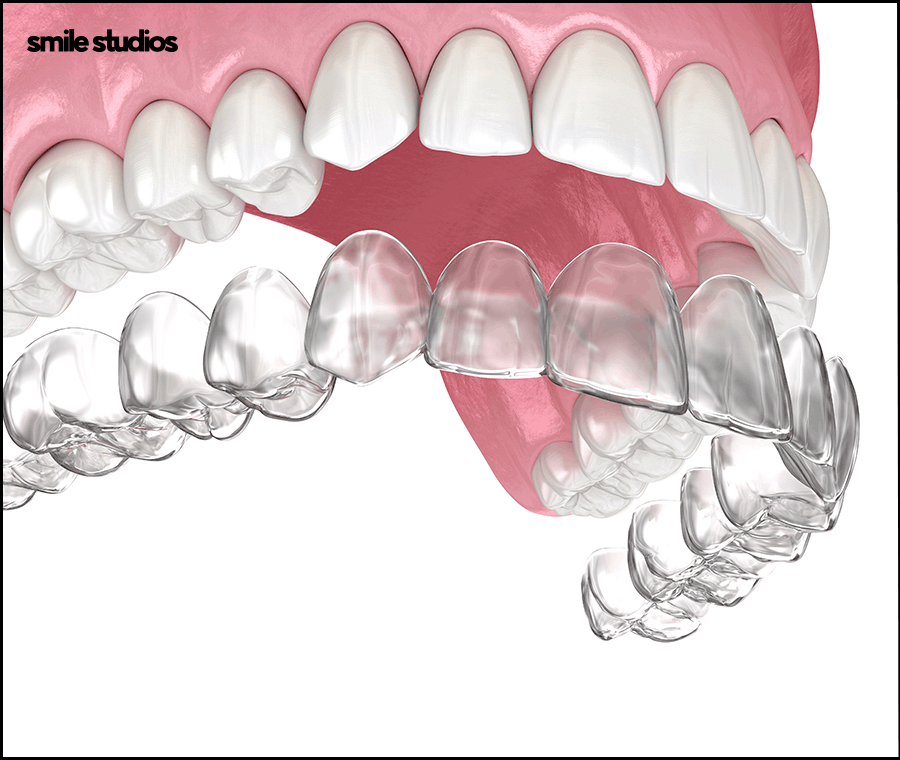 강남 인비절라인 찾는 이유, 치료 가능 범위는? 관련 이미지 2
