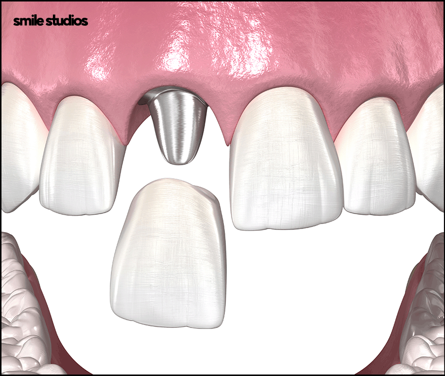 도산대로치과 앞니 라미네이트 크라운 차이점 관련 이미지 7
