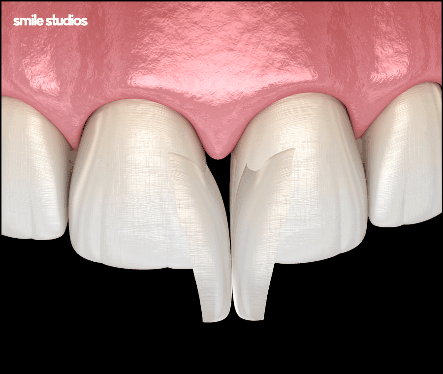 이빨사이벌어짐 부분 교정, 라미네이트 선택 Tip 관련 이미지 9