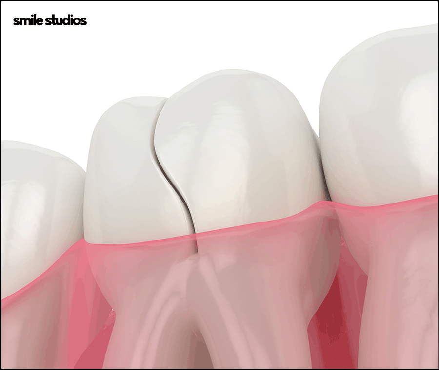 신사동치과 라미네이트 수명 늘리는 방법 A to Z 관련 이미지 7