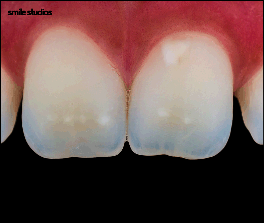 치아반점치 흰얼룩 발생하는 원인, 회복 방법 관련 이미지 2