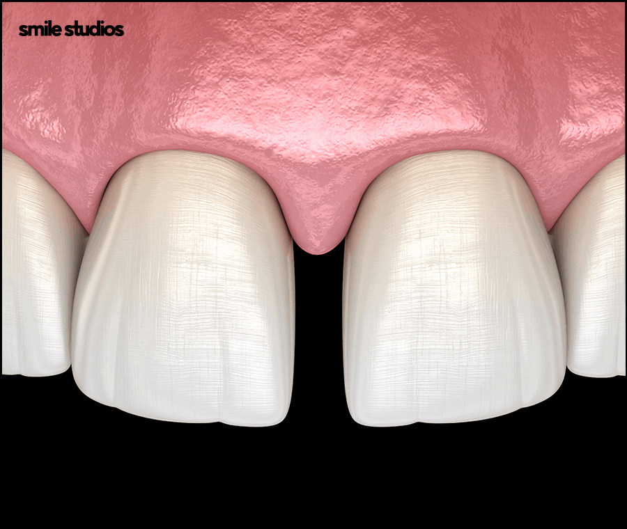 앞니 벌어짐 교정? 라미네이트? 케이스별 추천 방법 관련 이미지 3