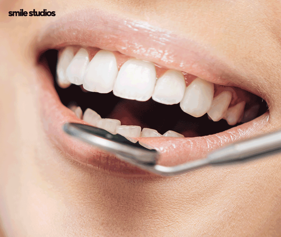 학동역치과 라미네이트 고민된다면 사전에 확인할 점 관련 이미지 9