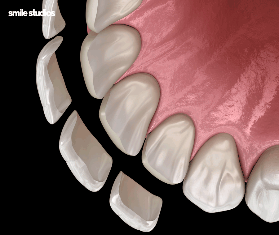 라미네이트 빠짐, 재부착 가능할까요? +대처방법 관련 이미지 4