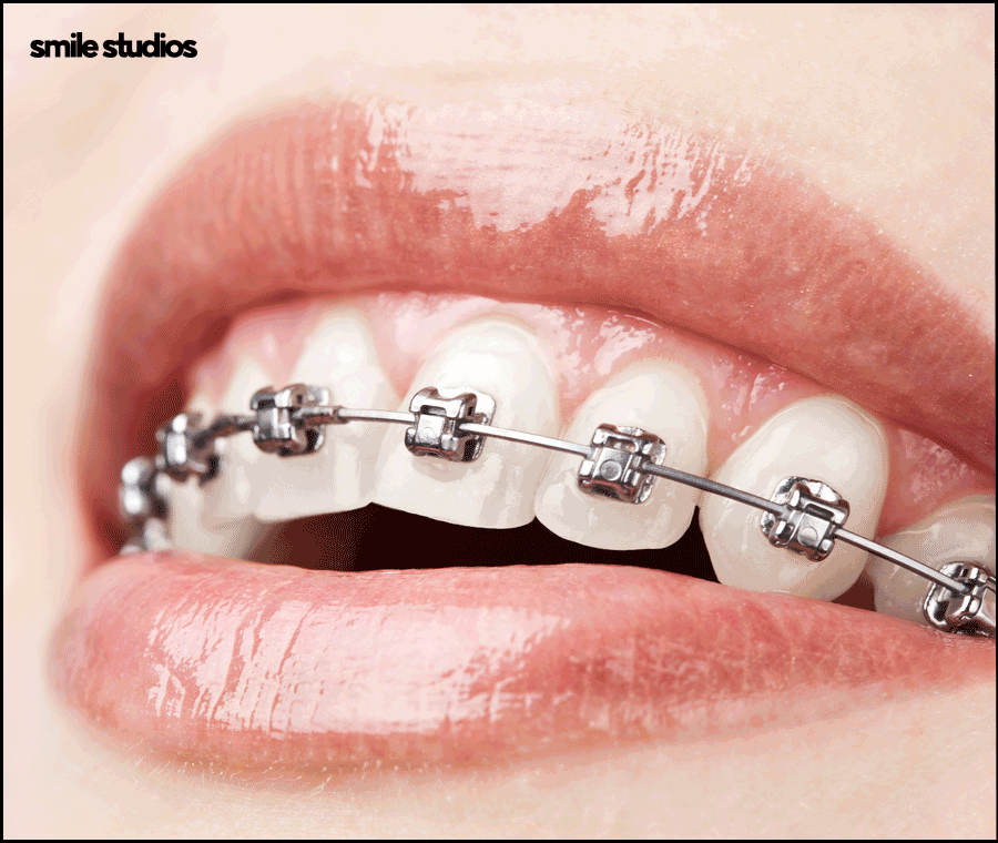 역삼역치과 인비절라인, 브라켓과 차이점 알아보기 관련 이미지 7