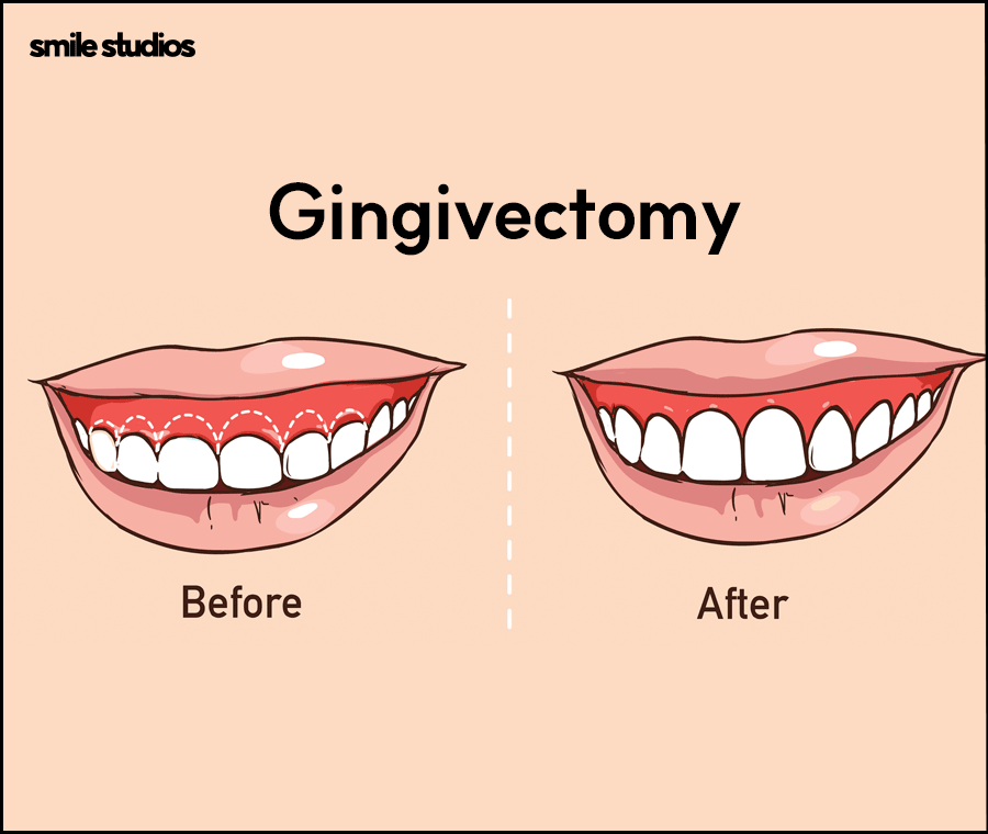 거미스마일 앞니 잇몸 과노출, 원인 및 보완 방법 관련 이미지 7