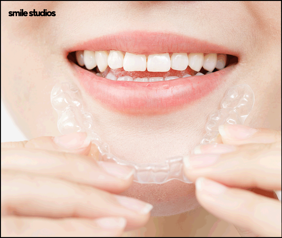 서울인비절라인 권장 케이스, 장점, 치료 시간 정리 관련 이미지 8