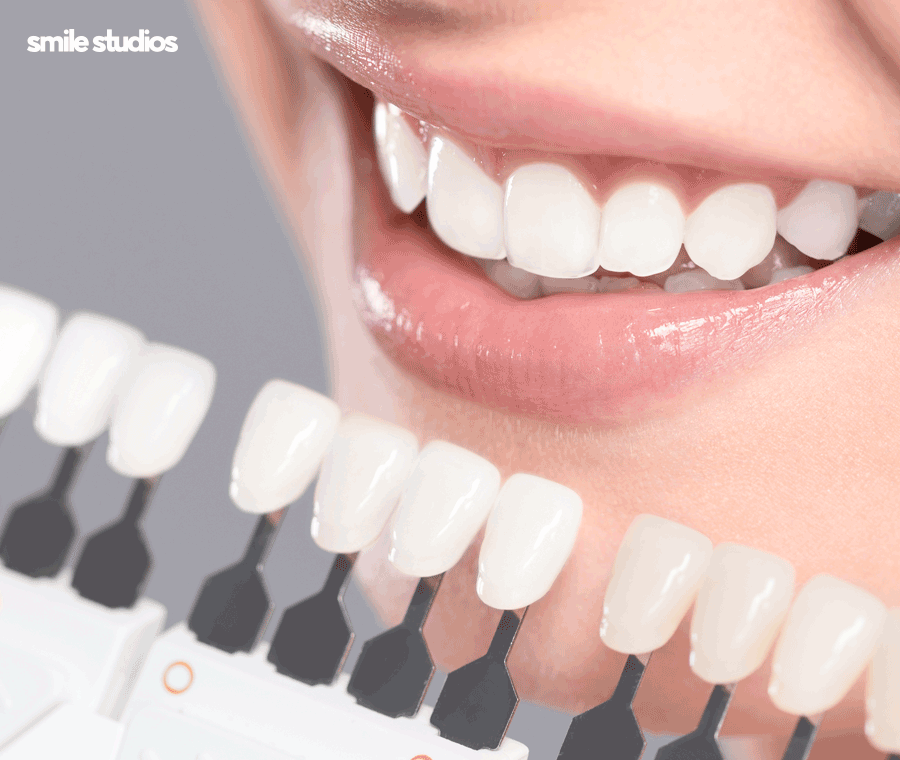 심미보철 가격, 기준, 시술 전 확인사항 총 정리 관련 이미지 3