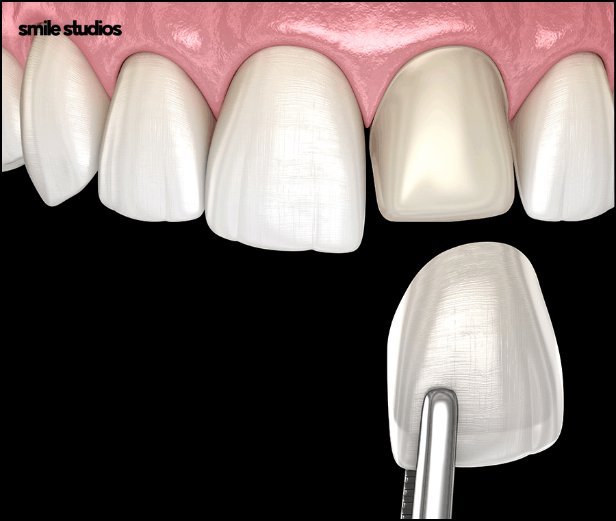 강남라미네이트 기대 효과, 원리, 유지기간 관련 이미지 3