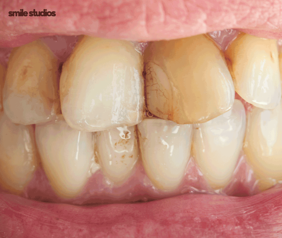 강남역 교정치과 삐뚠 앞니, 부분 치료 괜찮을까? 관련 이미지 2