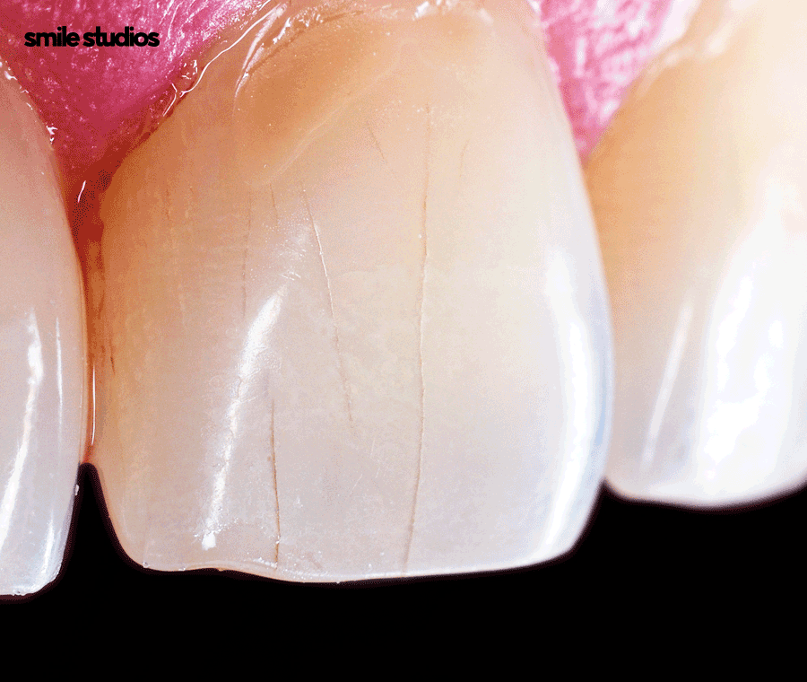 앞니 살짝 깨짐 라미네이트로 대처 가능한 수준은? 관련 이미지 3