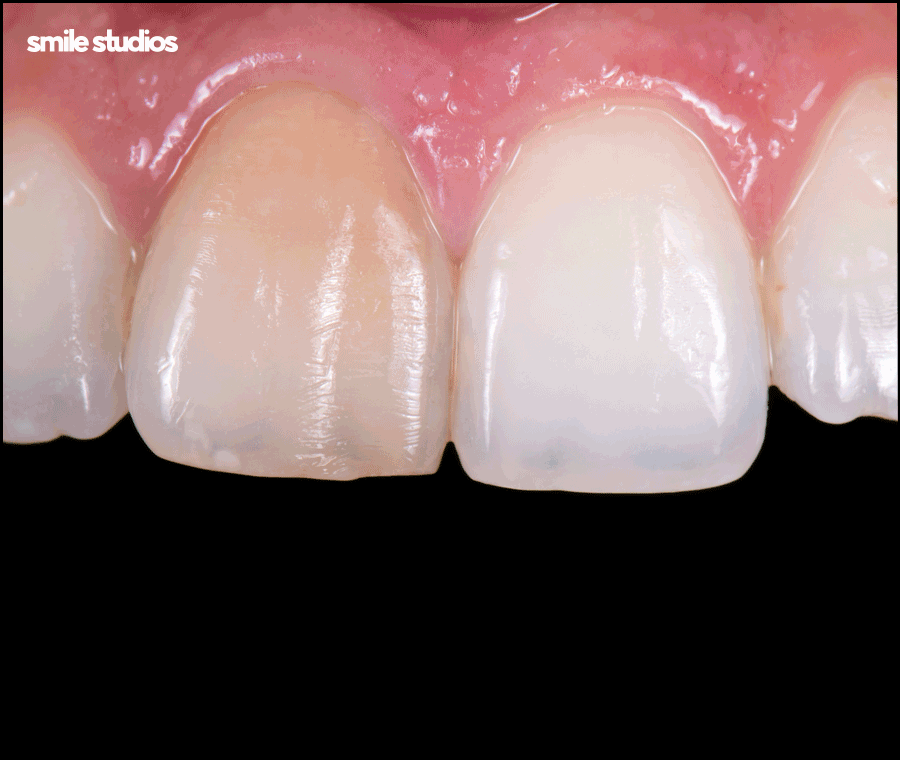 라미네이트 깨짐 대처, 어떻게 해야할까요? 방법 정리 관련 이미지 6