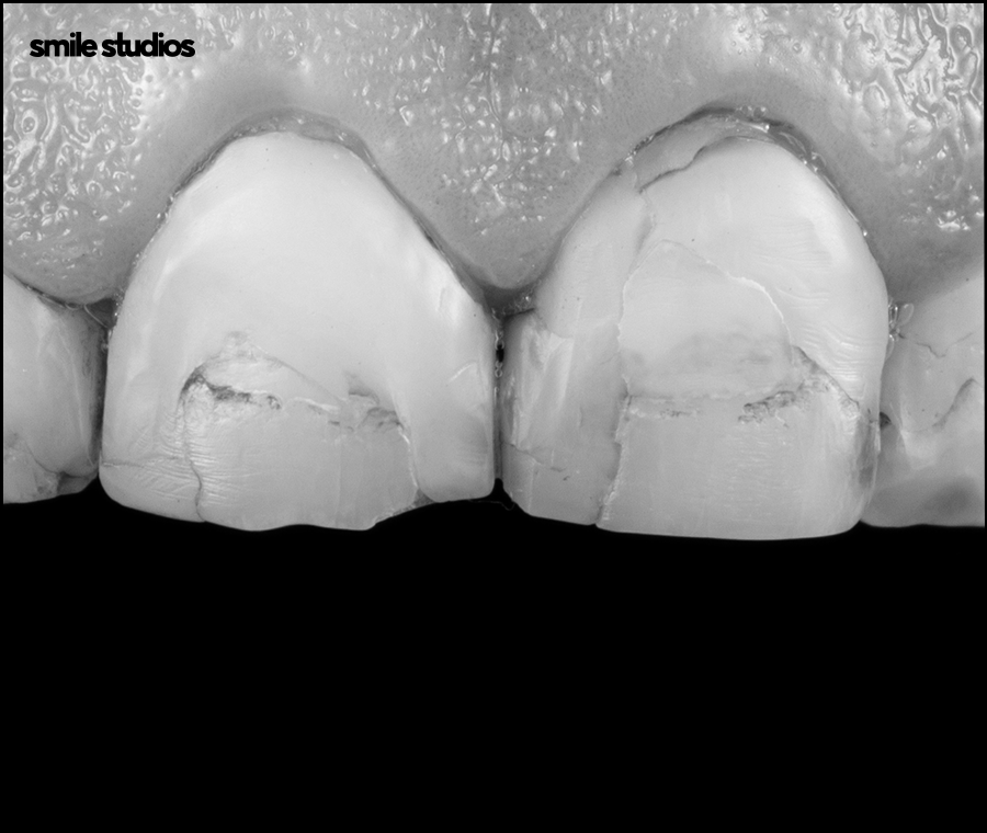앞니부러짐 치아파절 대처 방법은? ft. 라미네이트 관련 이미지 6