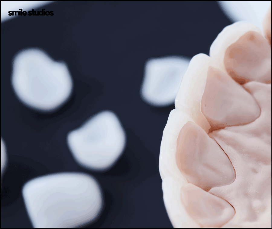 압구정로데오치과 라미네이트 하기 전 체크할 사항 관련 이미지 6