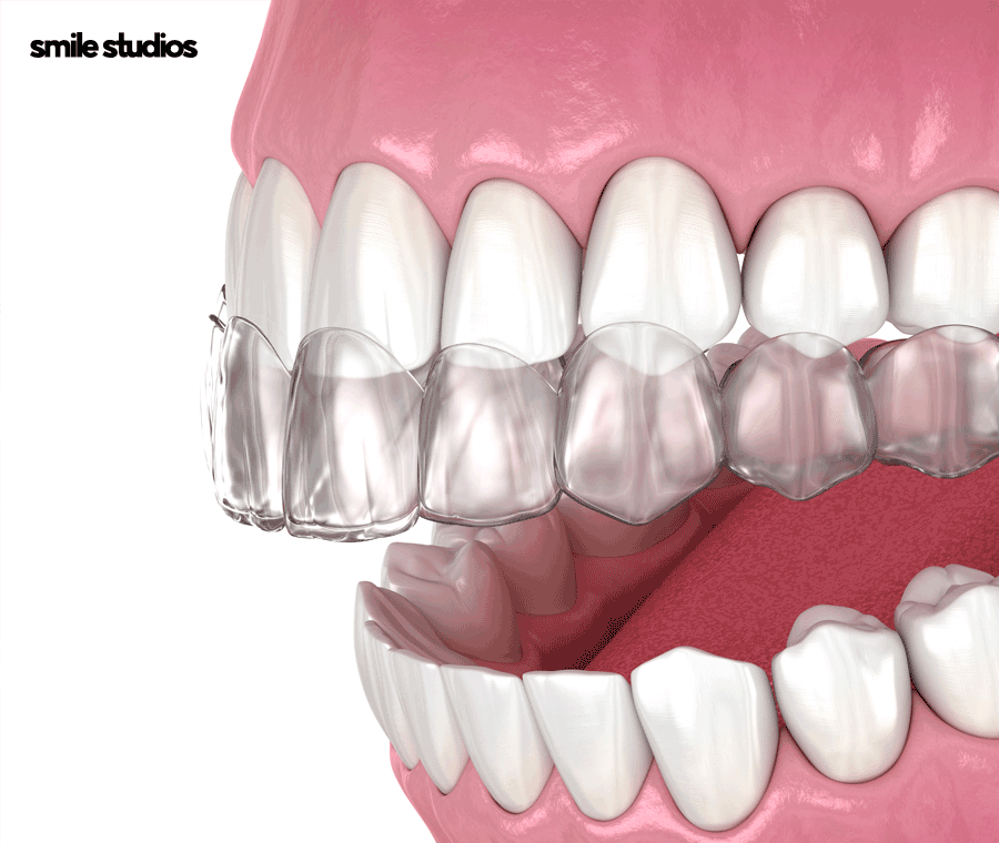 투명교정후기 알아본다면 함께 꼭 확인해야 할 2가지 관련 이미지 3