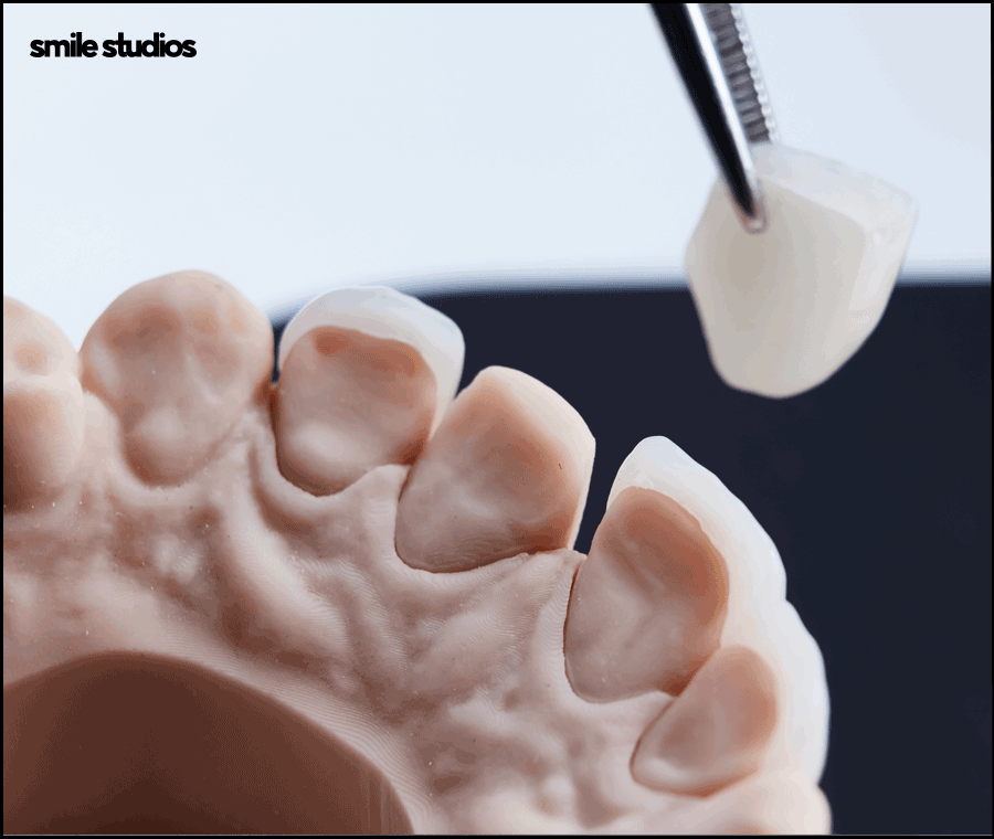 라미네이트 재시술 필요한 케이스, 주의사항 정리 관련 이미지 6
