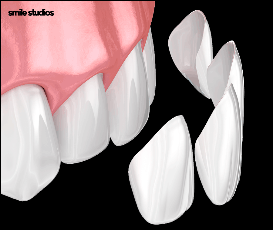 논현역 치과 라미네이트 시술 전 필수 확인 사항 관련 이미지 4