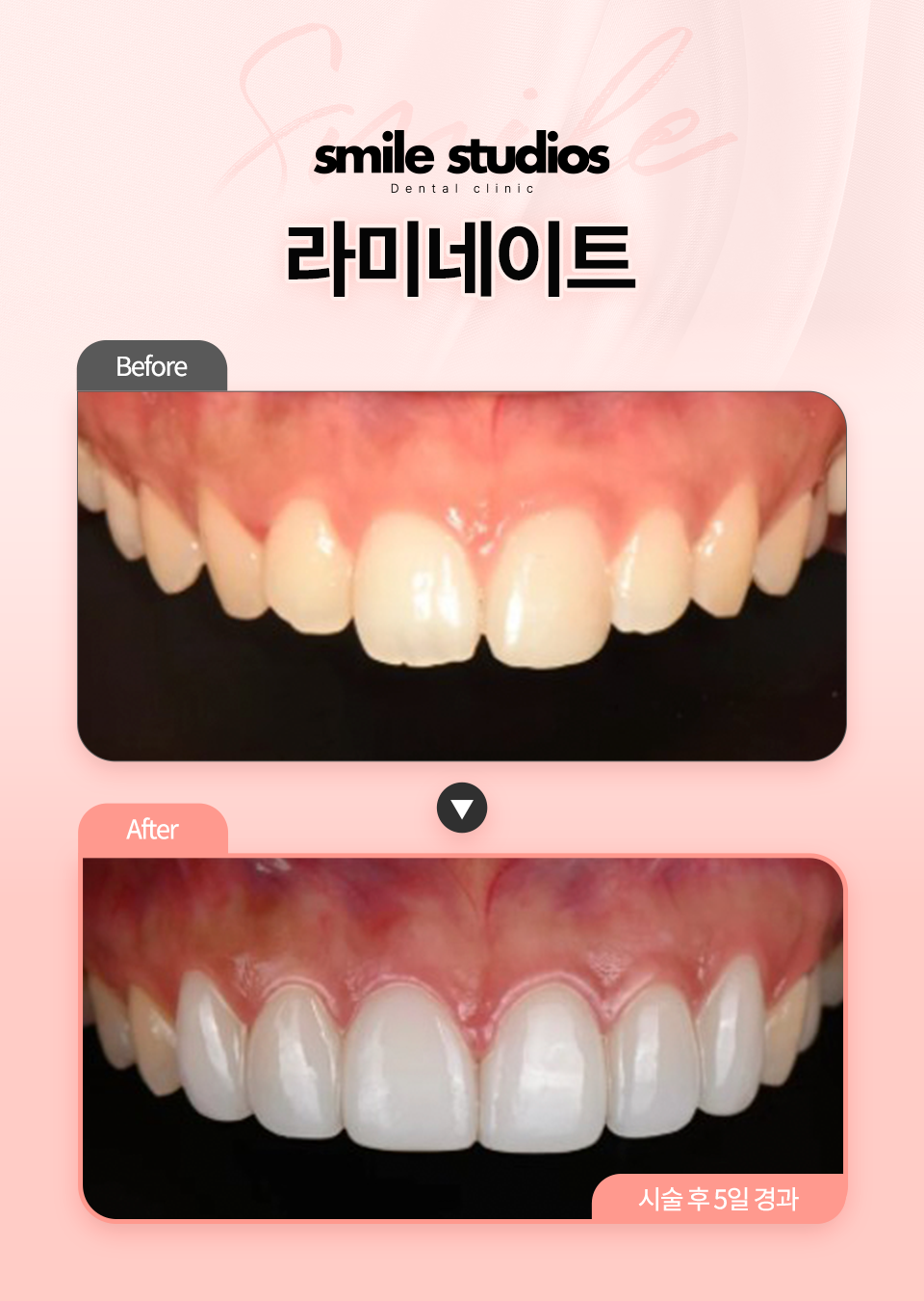 라미네이트 후기, 이것 모르면 100% 후회합니다 관련 이미지 6