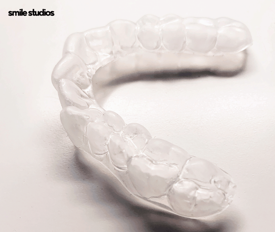 중년치아교정 소요 시간 포함 시작 전 체크할 사항 관련 이미지 6