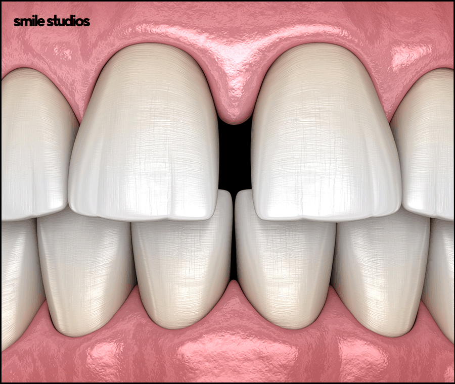앞니 벌어짐 교정? 라미네이트? 케이스별 추천 방법 관련 이미지 2