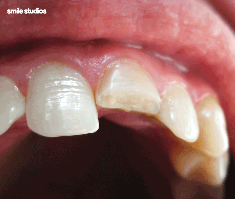 이빨깨짐 치료 치기를 놓치면 위험한 이유는? 관련 이미지 7