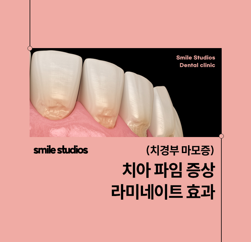 역삼역 치과, 치아 파임 증상 라미네이트 효과는? 관련 이미지 1