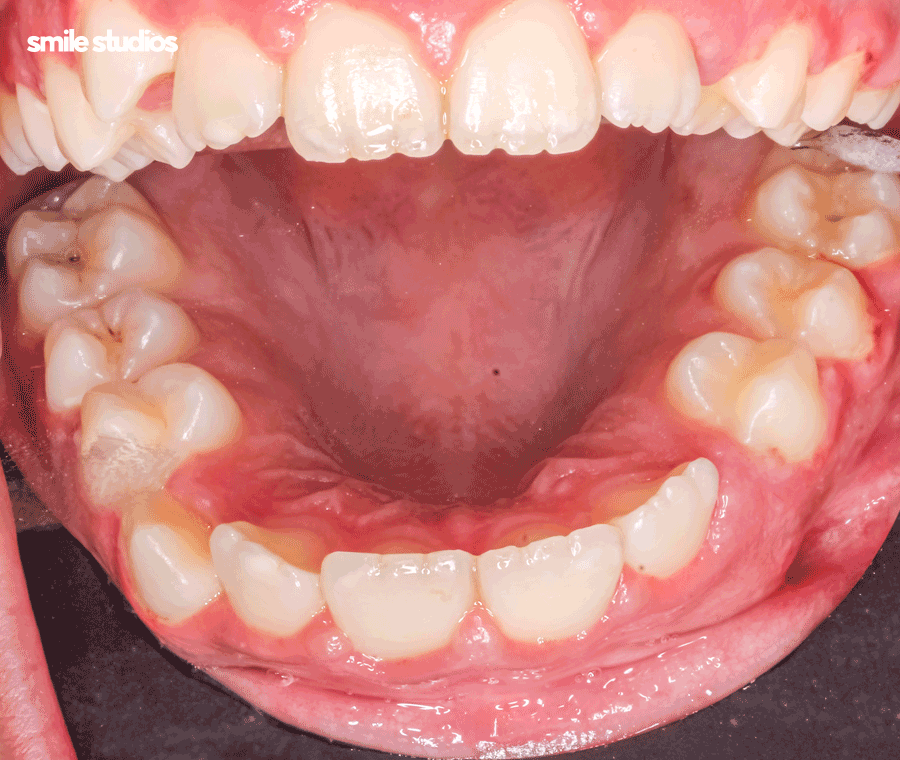 강남 논현 치과 투명 치아교정 시작 전 확인사항 관련 이미지 8