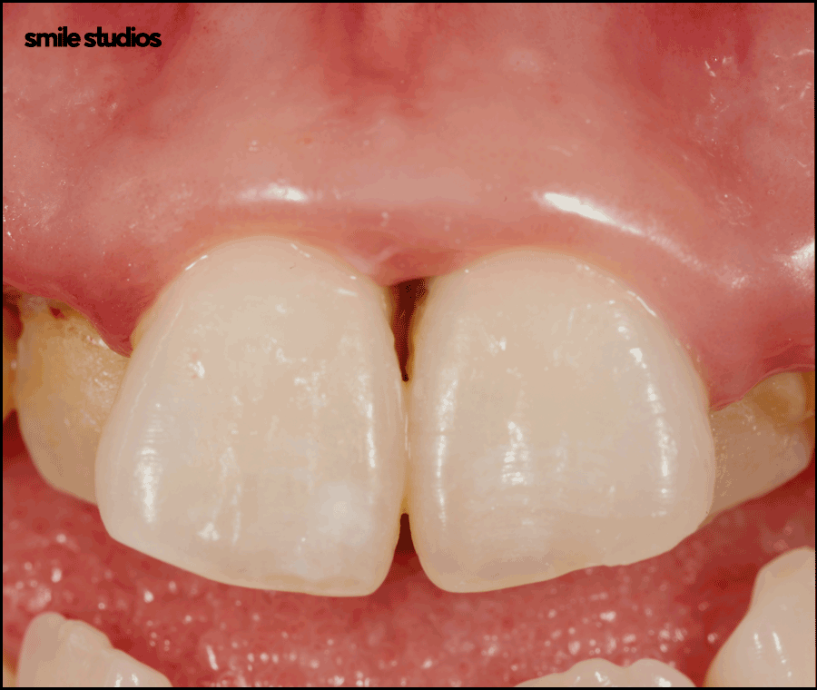 블랙트라이앵글 치료 적합한 방법 알아보기 관련 이미지 3