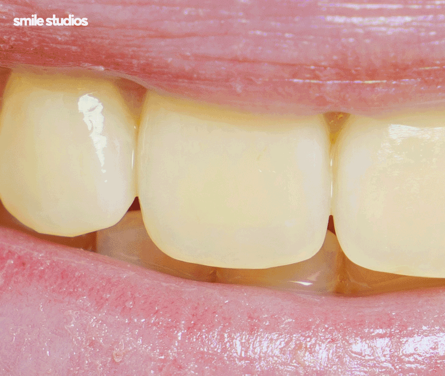 연예인 라미네이트 자연스러운 미소의 비밀은? 관련 이미지 8